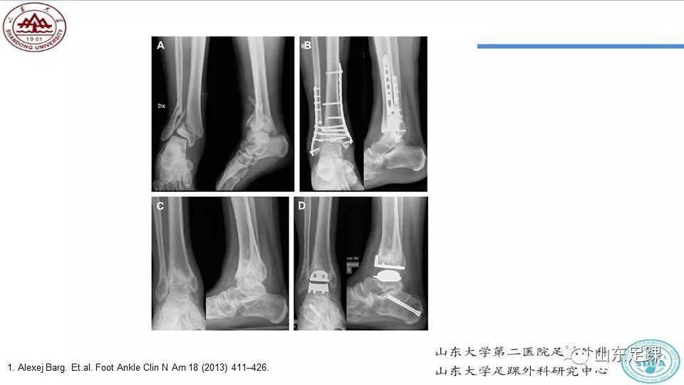 踝关节骨关节炎的分型及治疗策略