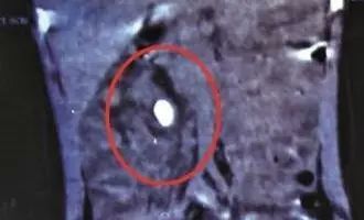 2岁女娃喝液态奶得肾结石,婴幼儿配方奶粉才是