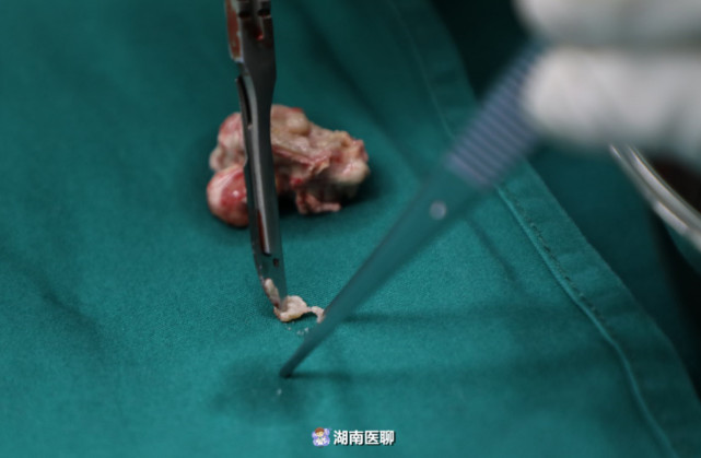 常德男童爱玩蝌蚪不洗手吃东西 寄生虫上脑左