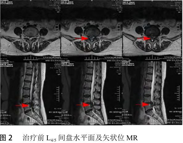 巨大腰椎间盘脱出术后重吸收 1 例