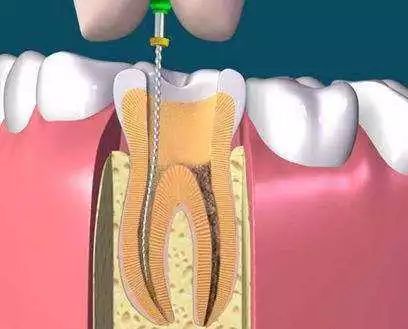 对于那些牙髓炎,牙髓坏死,各种类型的根尖周炎都适于作根管治疗,包括