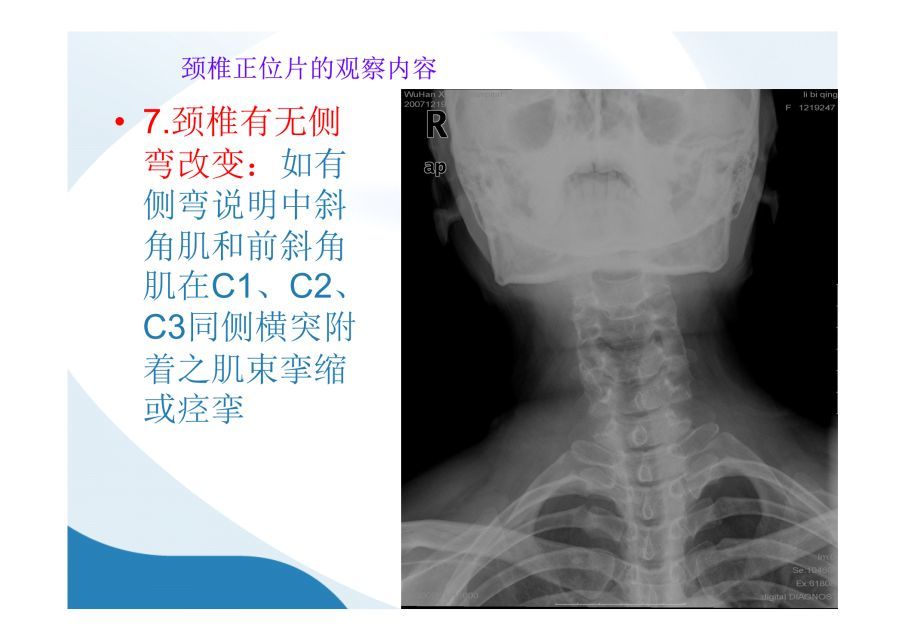 颈椎x光片讲解