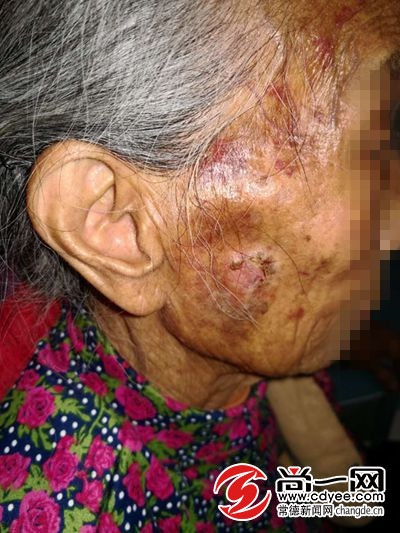 常德96岁老人面部瘙痒难耐 竟是鳞癌做祟