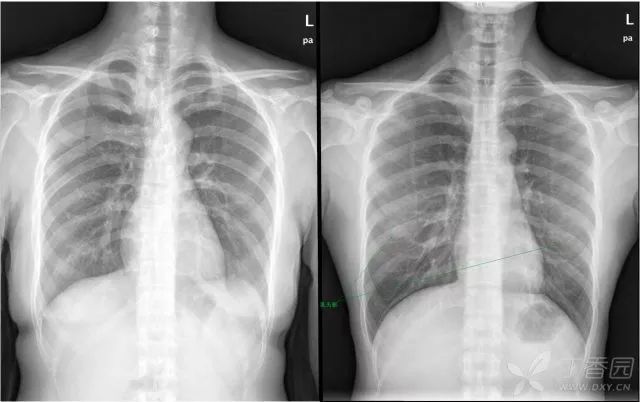 如何读好一张胸片你和主任就差这4点