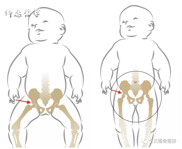 关于宝宝腿型,这14个问题你应该知道