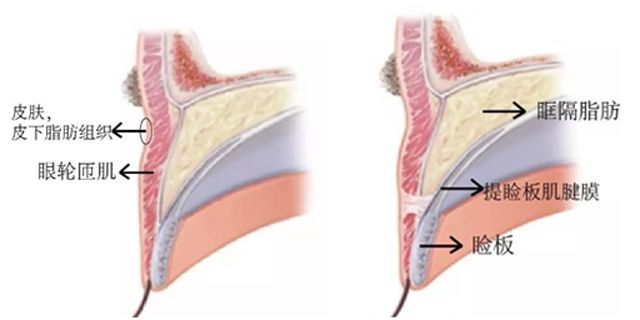 中层(眶隔膜,眶隔脂肪层),后层(提上睑肌腱膜,提上睑肌,睑板,muller肌