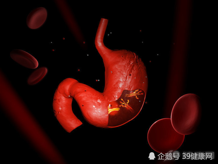 幽门螺旋杆菌:你的胃就是被我拖垮的,3大后果