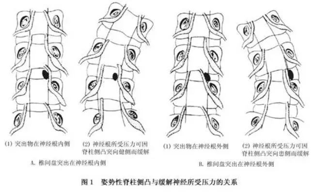 最全腰椎间盘突出症诊断与治疗