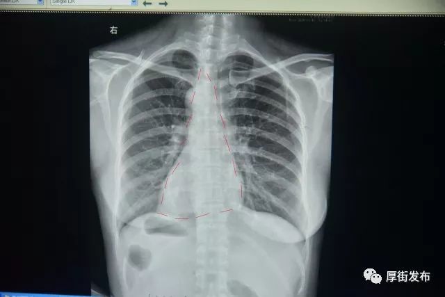 東莞一病人“五臟六腑”全長反 醫(yī)生：做手術(shù)如腦筋急轉(zhuǎn)彎
