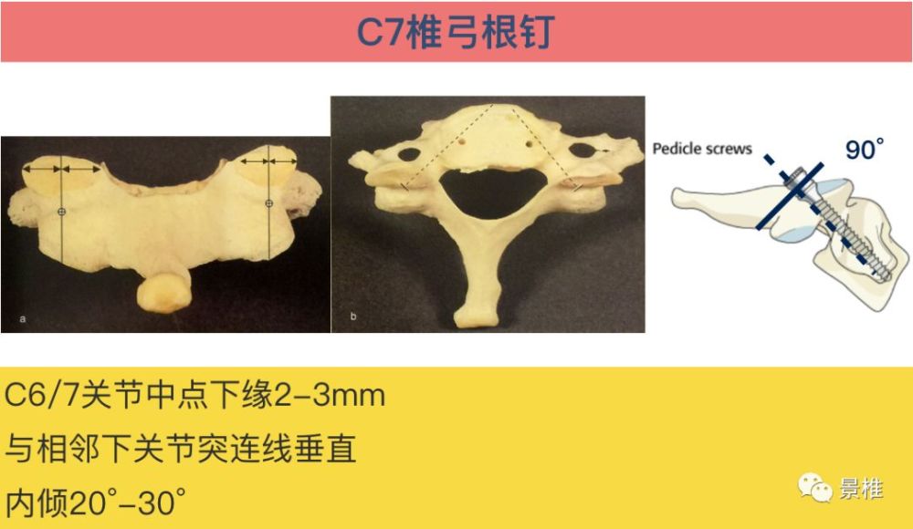 骨科精读颈椎胸椎腰椎椎弓根置钉技巧真的太实用了