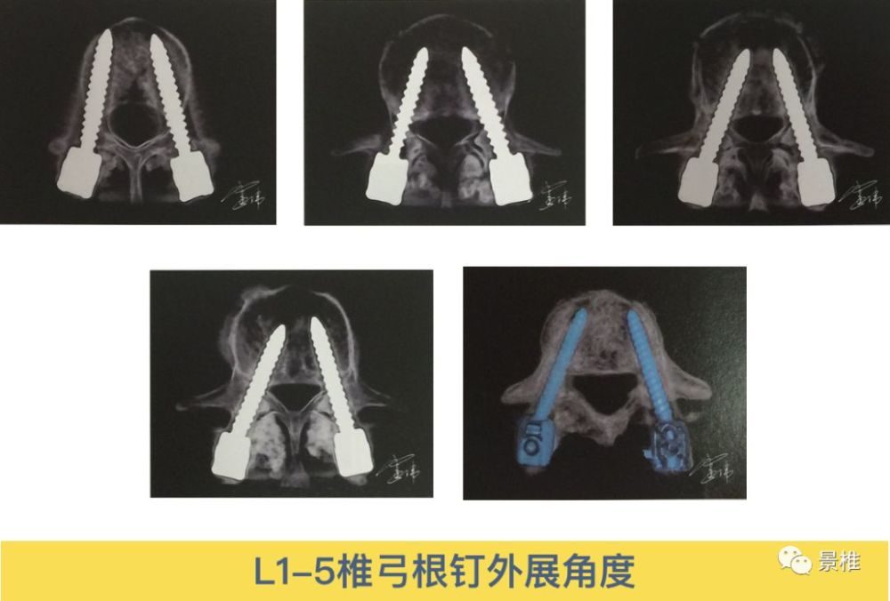 骨科精读颈椎胸椎腰椎椎弓根置钉技巧真的太实用了