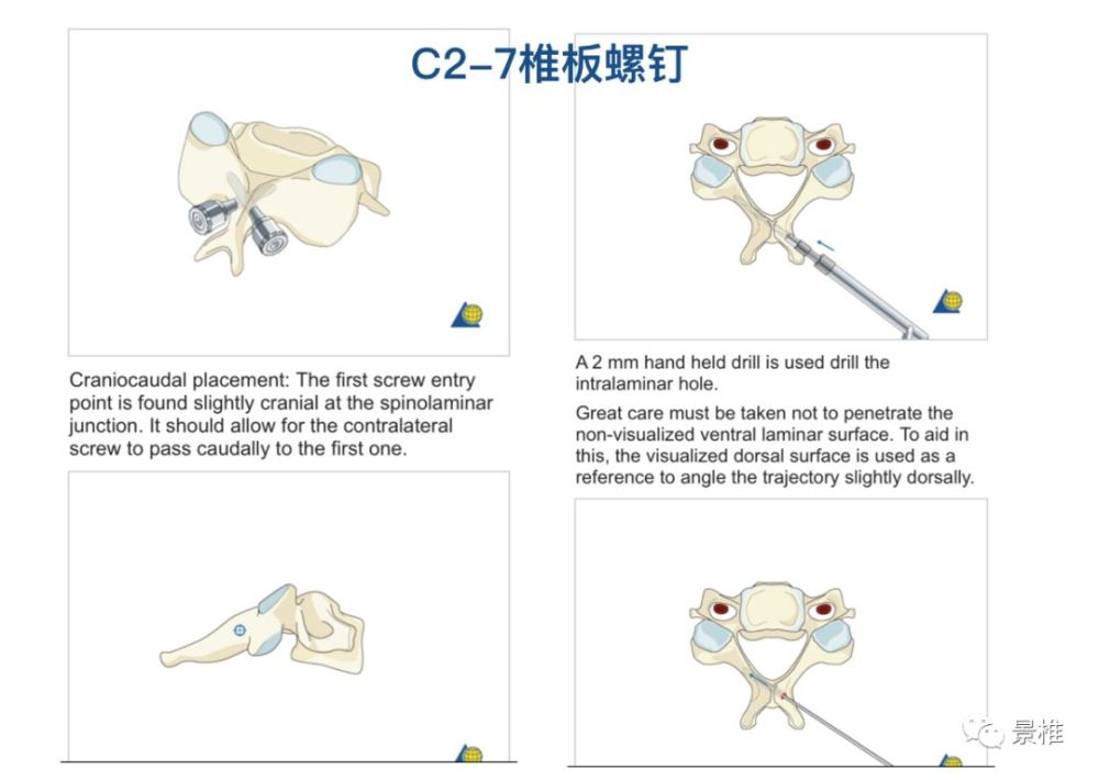 骨科精读颈椎胸椎腰椎椎弓根置钉技巧真的太实用了