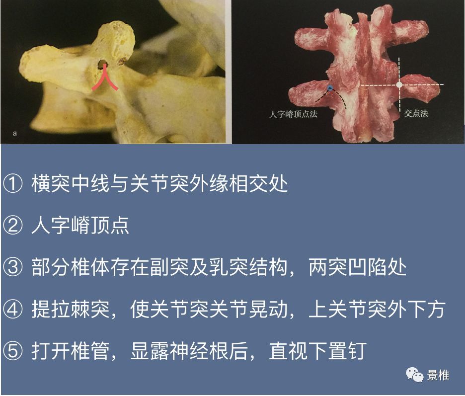 骨科精读颈椎胸椎腰椎椎弓根置钉技巧真的太实用了