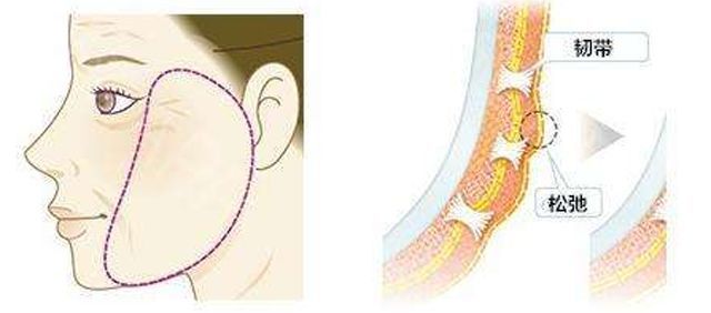 结构的作用,而衰老的主要原因就是软组织韧带的松弛,脂肪萎缩和移位