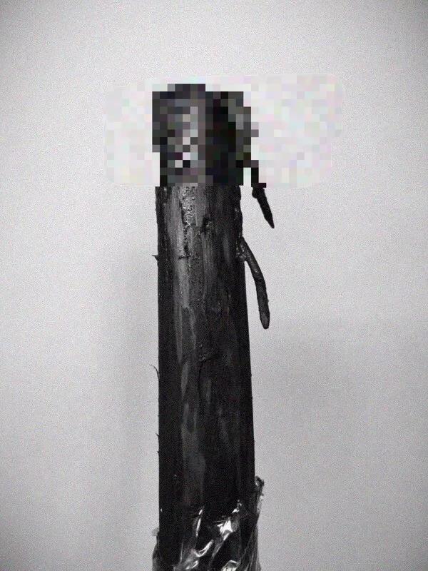 惊悚!宁波男子被木棍插穿胸部 医生与死神博弈