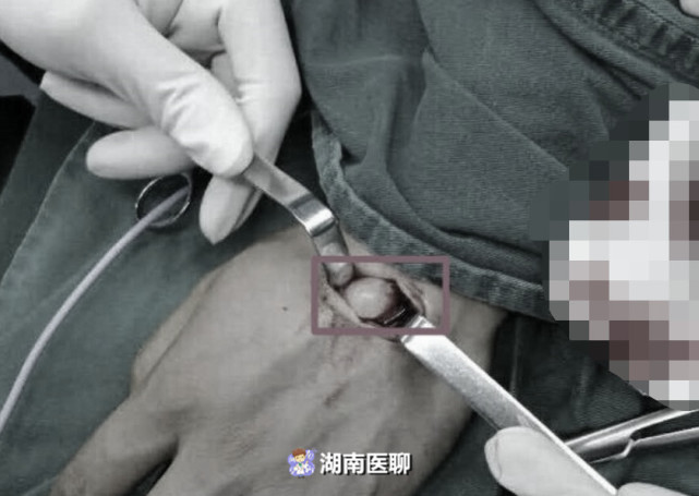 上班用电脑下班玩手机 长沙这位白领手背长了