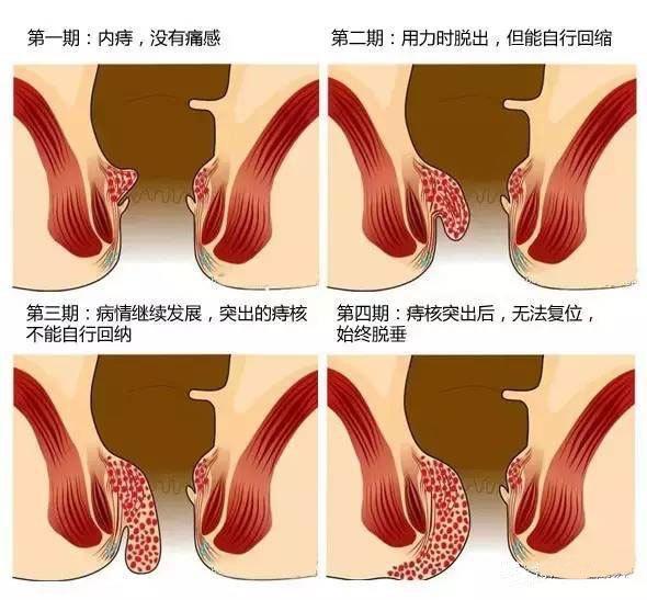 教你3个预防痔疮的好习惯,加上这种外敷,痔疮用过的都