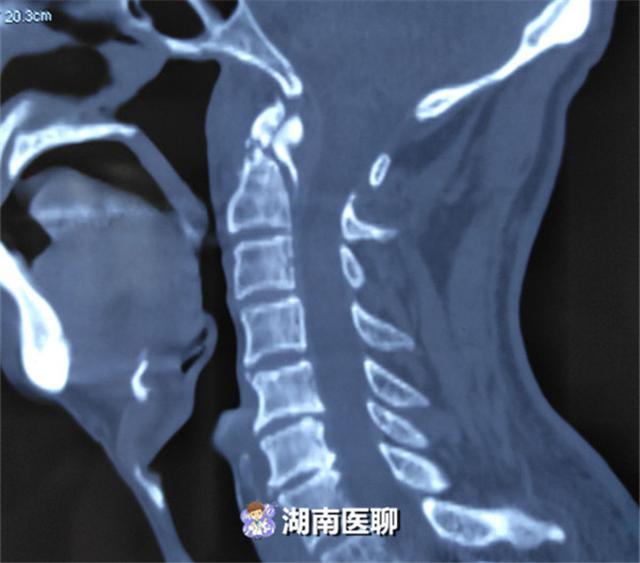 (齿状突骨折ct扫描)