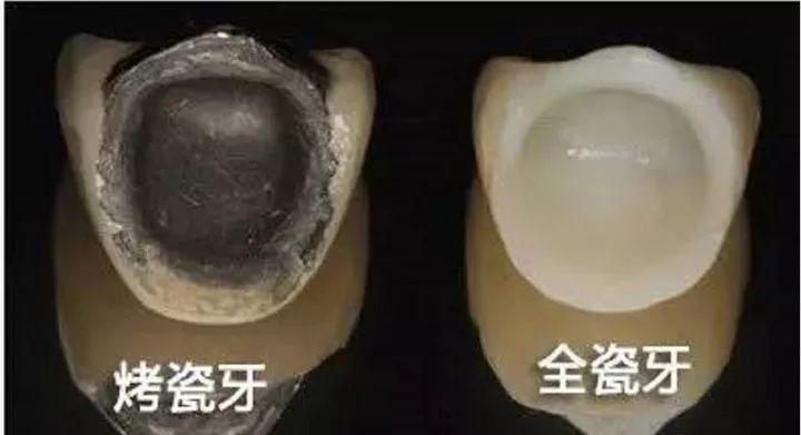 5,内外冠结合:金属和瓷的结合是烤瓷牙修复中比较薄弱的一个环节