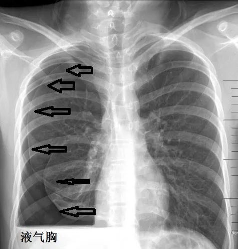 这样的气胸不少见胸腔穿刺需谨慎