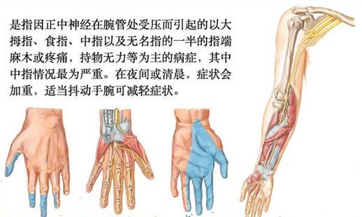 桡神经沟卡压:c.