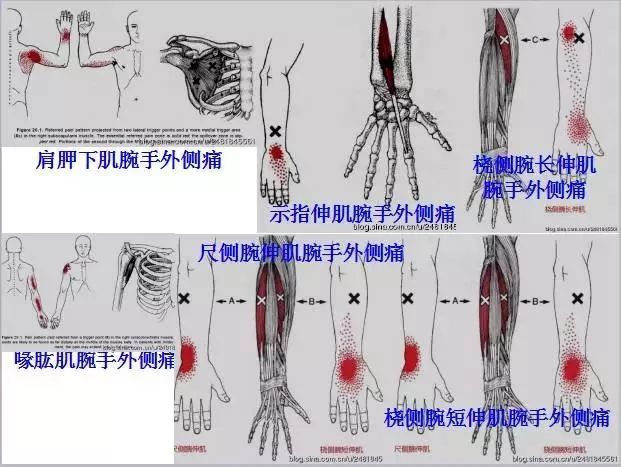 是建立在现代软组织损伤理论的基础之上,因此,要学习激痛点针刺疗法