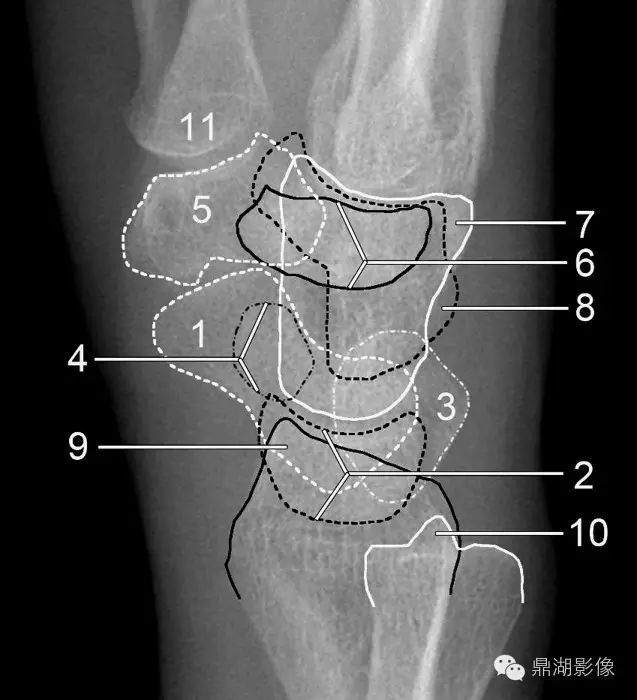 x线高清图谱|精致腕关节解剖_腾讯新闻