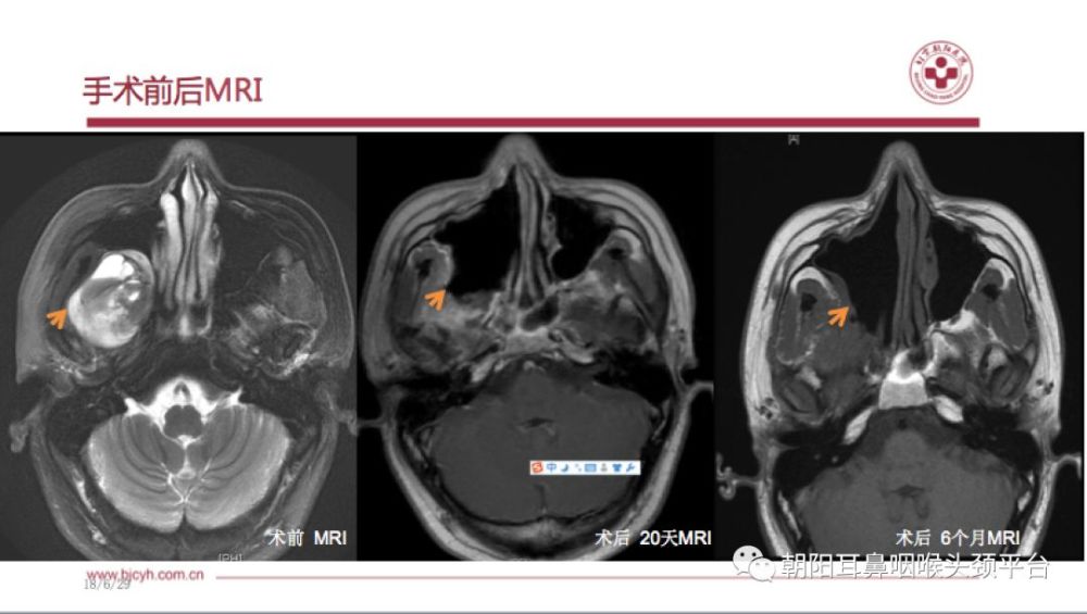 手术分享:内镜下经鼻翼腭窝神经鞘瘤切除术