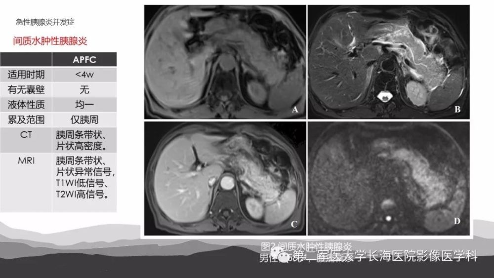 坏死性急性胰腺炎的影像诊断和治疗