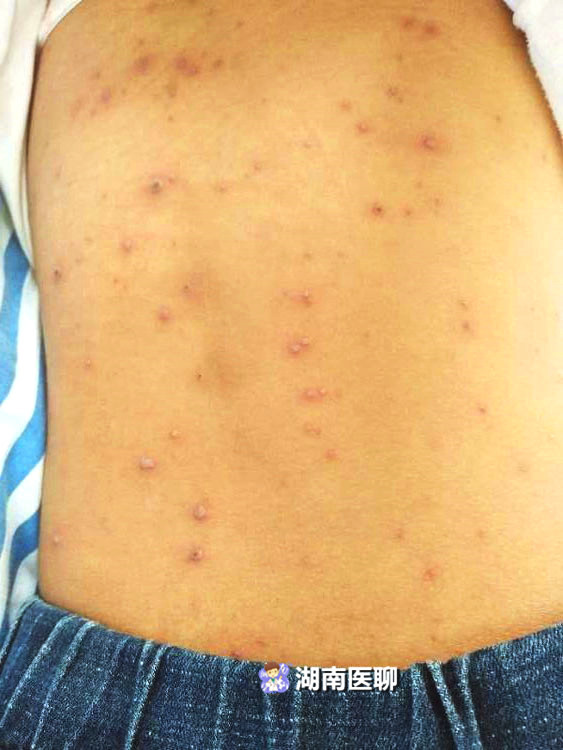 衡阳13岁女孩全身长满水泡 感染的是见面传