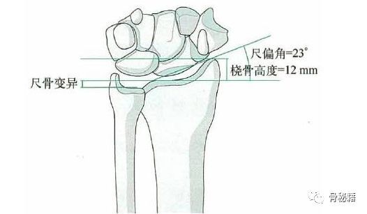 掌倾角,尺偏角,桡骨高度,尺骨差异