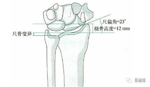 骨科精读下尺桡远端骨折复位技巧你知道吗