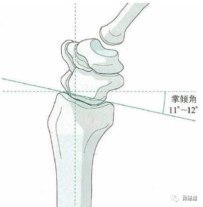 掌倾角,尺偏角,桡骨高度,尺骨差异