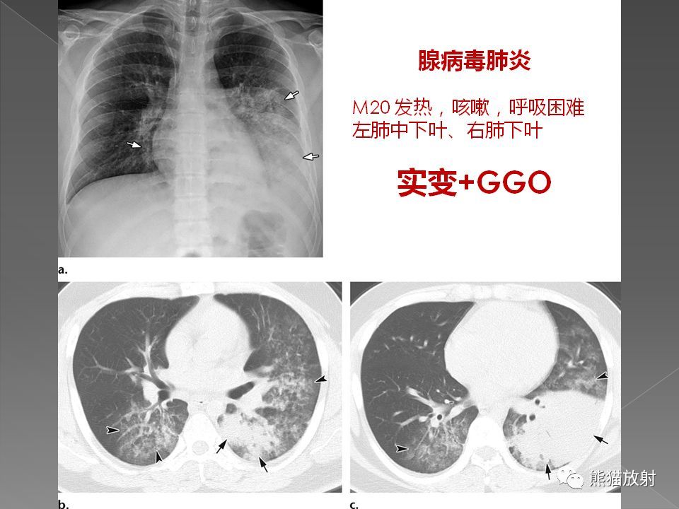 下文是一篇来自权威杂志radiographics的关于病毒性肺炎的影像学表现