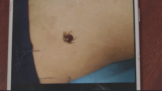 老人臀部有颗痣 仔细一看原来是一只蜱虫