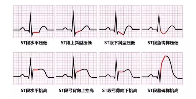 可以呈水平上抬,弓背向上抬高,弓背向下抬高,有时候干脆和