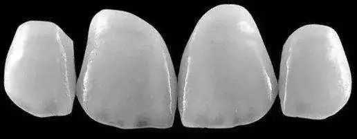 十几块钱、一贴就变白的牙贴面,是认真的吗?你