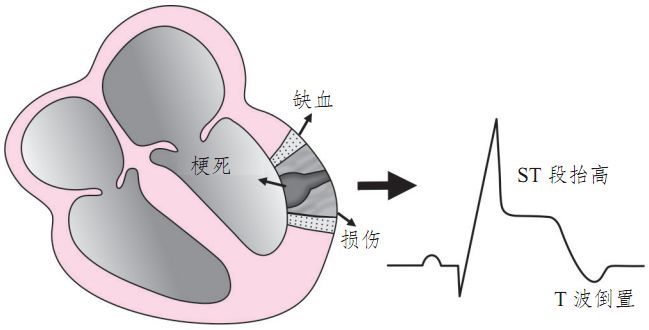 25张图表,吃透急性心肌梗死心电图