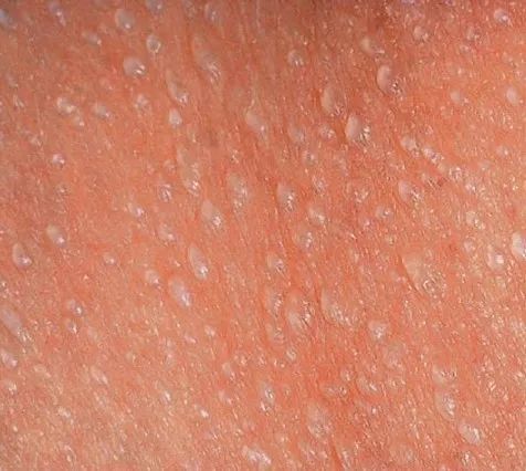 每种类型的症状和体征各不相同: 晶状痱 红痱皮肤深层,表现为红颗粒和