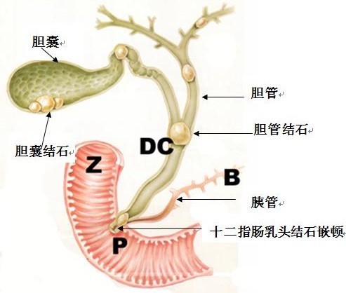 二,注意定期复查肝胆常规彩超,监测结石及胆囊的变化.