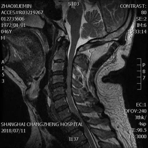 如此长的后纵韧带骨化,只有他们才敢直接手术