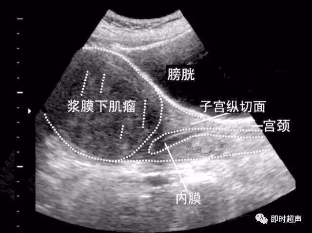 子宫肌瘤超声分类诊断