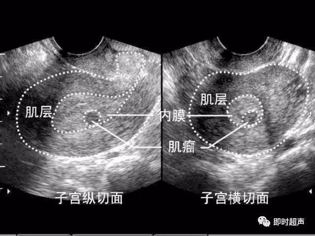 图8-3-10 阔韧带肌瘤声像图8-3-9 带蒂浆膜下子宫肌瘤声像图8-3-8