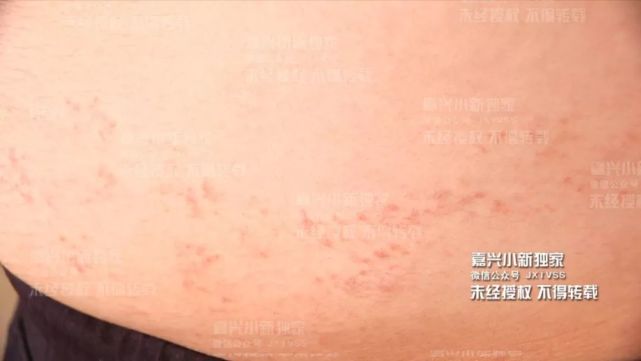 豪华泳池成养鱼池 男子游完泳身上长了红斑