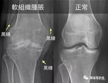 一篇推文搞懂常见膝关节疾病x光片判读