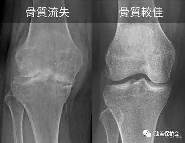 会产生很厉害的骨质流失,对比退化性膝关节炎的病患,x光可观察到 骨头