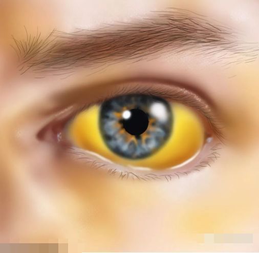 胆红素代谢也会出现异常,引起黄疸,通常表现为眼睛,皮肤,尿液等发黄