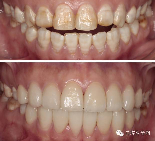 氟斑牙好尴尬,到底该如何治疗?