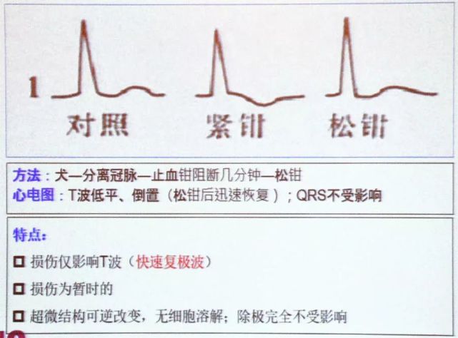 冠心病心肌缺血,如何用心电图进行定位诊断?