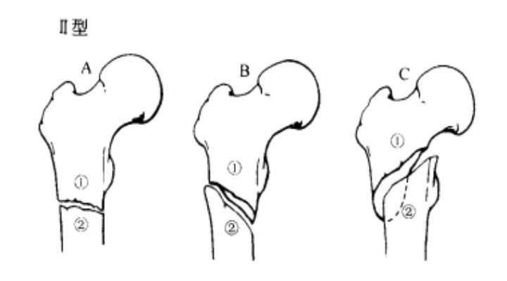 内收型:pauwels角>50度,为极不稳定型 iic:螺旋形两骨折块,小转子与远